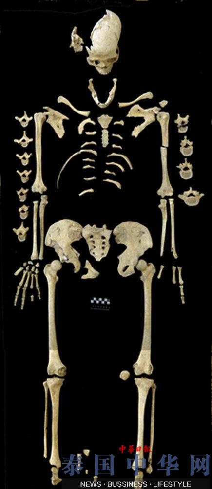 德国发现最古老白血病患者遗骸 距今7000年(图)